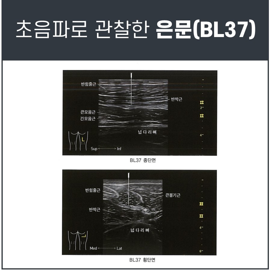 BL37 혈자리 주변의 햄스트링 근육과 넙다리뼈를 초음파로 관찰한 종단면 및 횡단면 이미지.