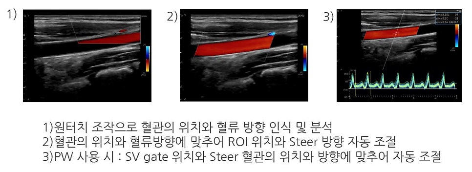 혈관의 위치와 혈류 방향을 인식하고 분석하며, ROI와 Steer 방향을 자동으로 조절하는 초음파 이미지와 PW 도플러 파형 — 초음파 정밀 진단 | 서울 바로한의원 초음파 약침·도침·침도
