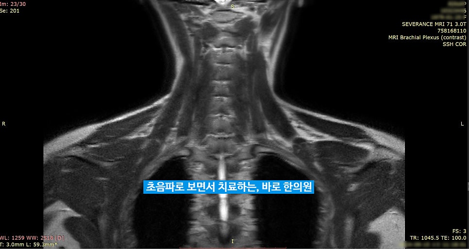 목과 어깨 부위의 상완신경총 MRI 영상입니다.