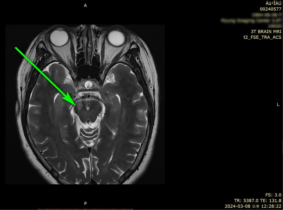 뇌 MRI 영상에서 녹색 화살표가 뇌간 부위를 가리키고 있다.