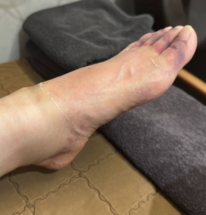 발등과 발가락에 붓기와 보라색 멍이 있는 발 사진
