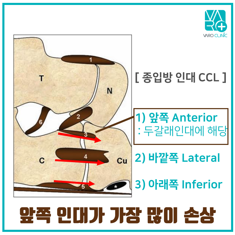 발목과 발의 뼈와 인대를 나타내는 해부학적 그림으로, 종입방 인대와 앞쪽 인대의 손상 가능성을 보여줍니다 — 서울 바로한의원 초음파 약침·도침