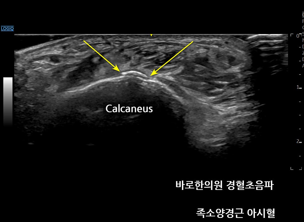 발목 종골(Calcaneus)의 초음파 영상으로, 뼈 표면의 불규칙한 부분을 노란색 화살표가 가리키고 있다.