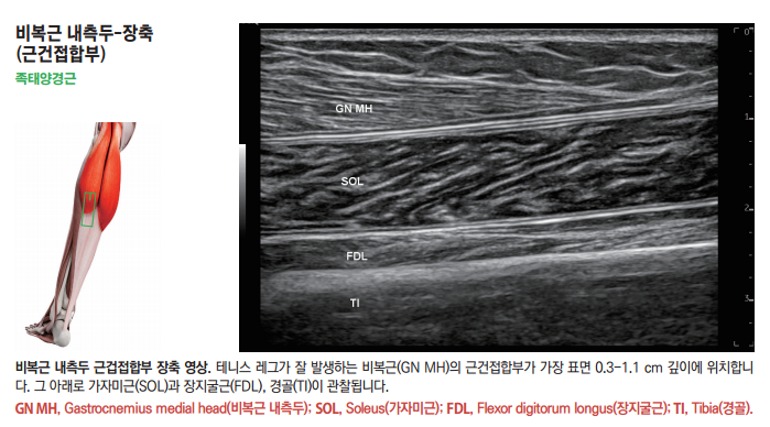 종아리 근육 해부도와 비복근 내측두, 가자미근, 장지굴근, 경골이 표시된 종아리 초음파 영상