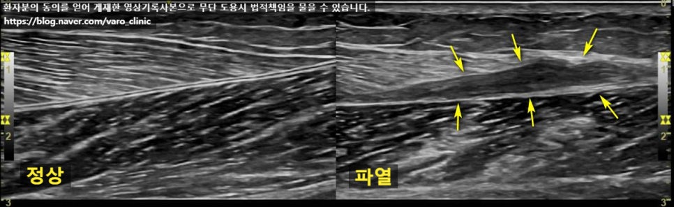 정상 종아리 근육과 파열된 종아리 근육을 보여주는 초음파 사진.