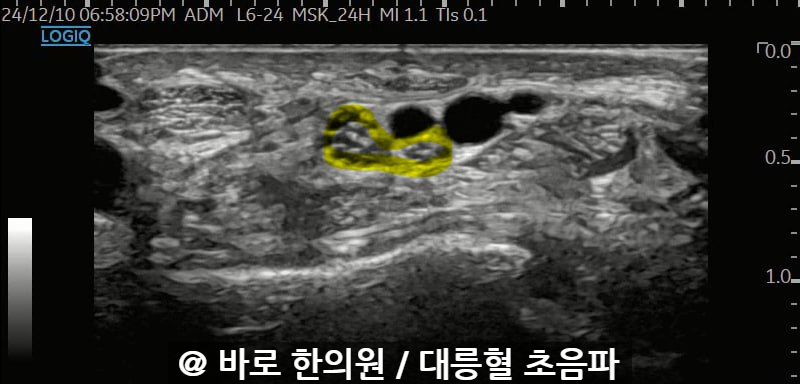 손목 부위의 초음파 사진으로, 노란색으로 표시된 신경이 관찰된다.