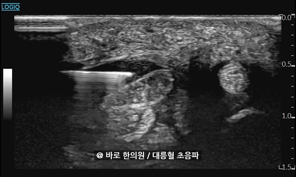대릉혈 부위에 침이 삽입된 초음파 영상