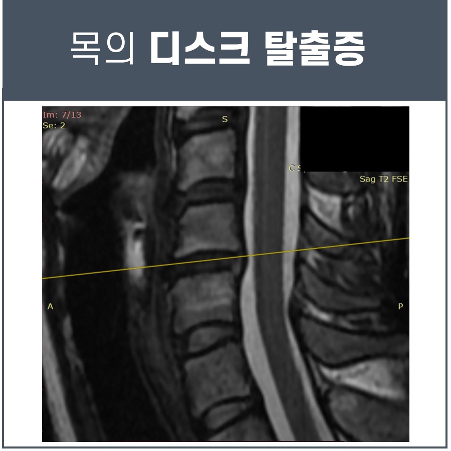 목 디스크 탈출증을 보여주는 경추 MRI 사진