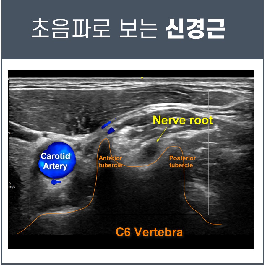 초음파로 촬영한 경동맥, 신경근, C6 척추의 모습