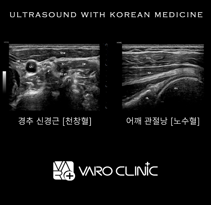 한의원에서 촬영한 경추 신경근과 어깨 관절낭 초음파 사진