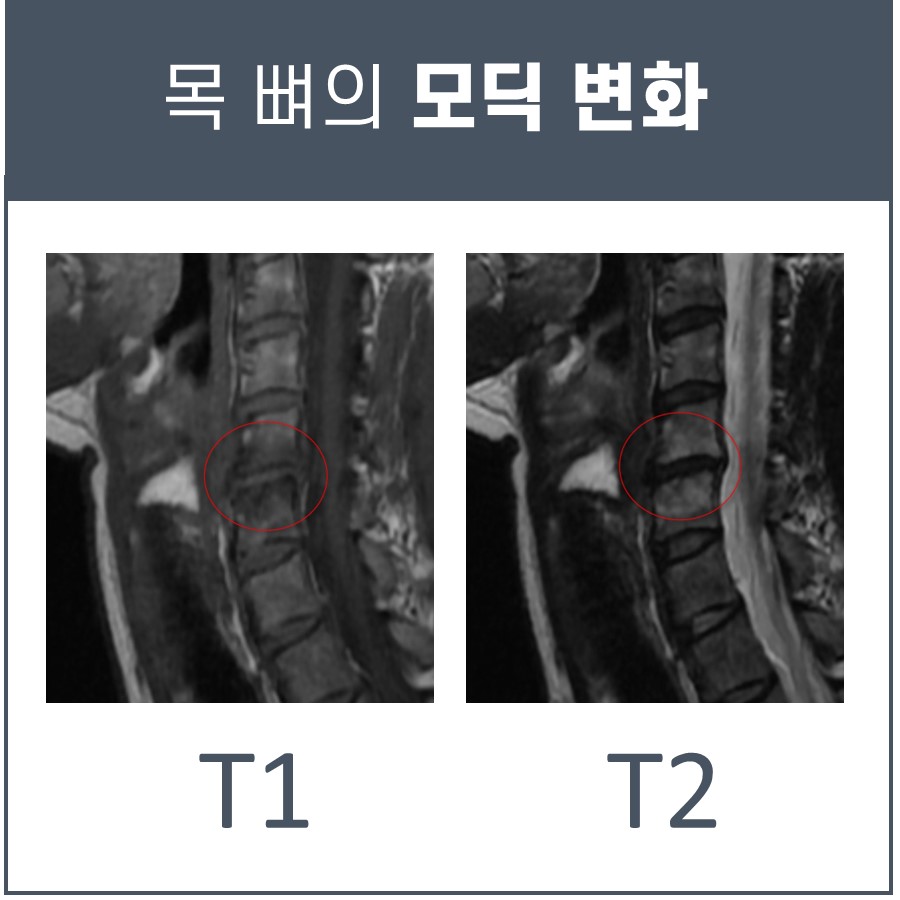 목뼈의 모딕 변화를 보여주는 T1, T2 MRI 영상 두 장. 빨간색 원으로 변화 부위가 표시되어 있다.