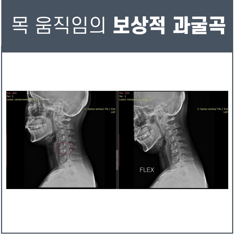목 움직임의 보상적 과굴곡이라는 제목 아래, 경추 하단부를 붉은 원으로 표시한 왼쪽 경추 측면 엑스레이와 목을 굽힌(굴곡) 상태를 보여주는 오른쪽 경추 측면 엑스레이가 나란히 있다.