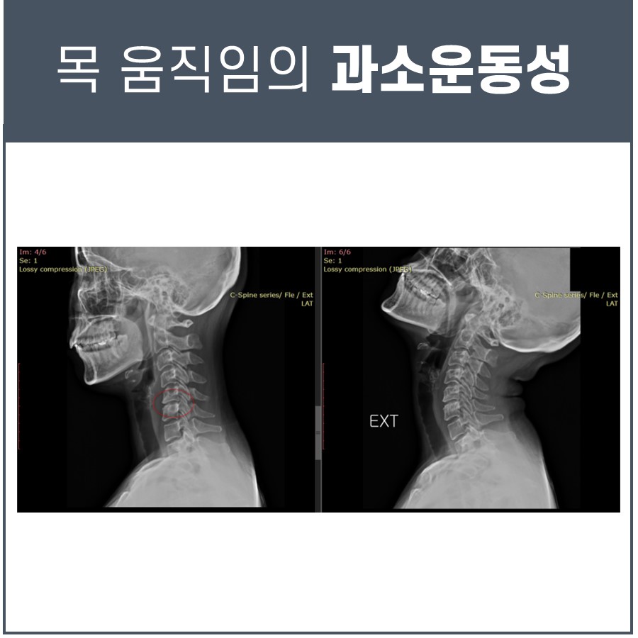 목 움직임의 과소운동성을 보여주는 경추 측면 X-ray 사진 두 장