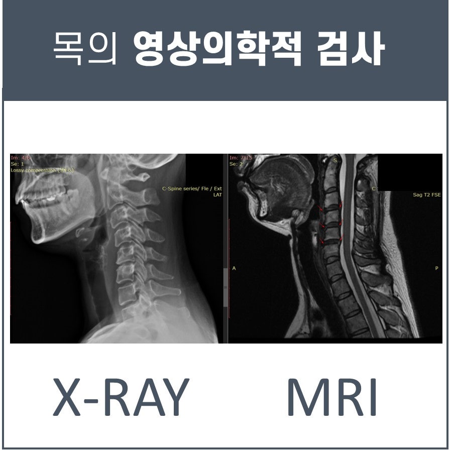 목 부위의 X-RAY와 MRI 영상.