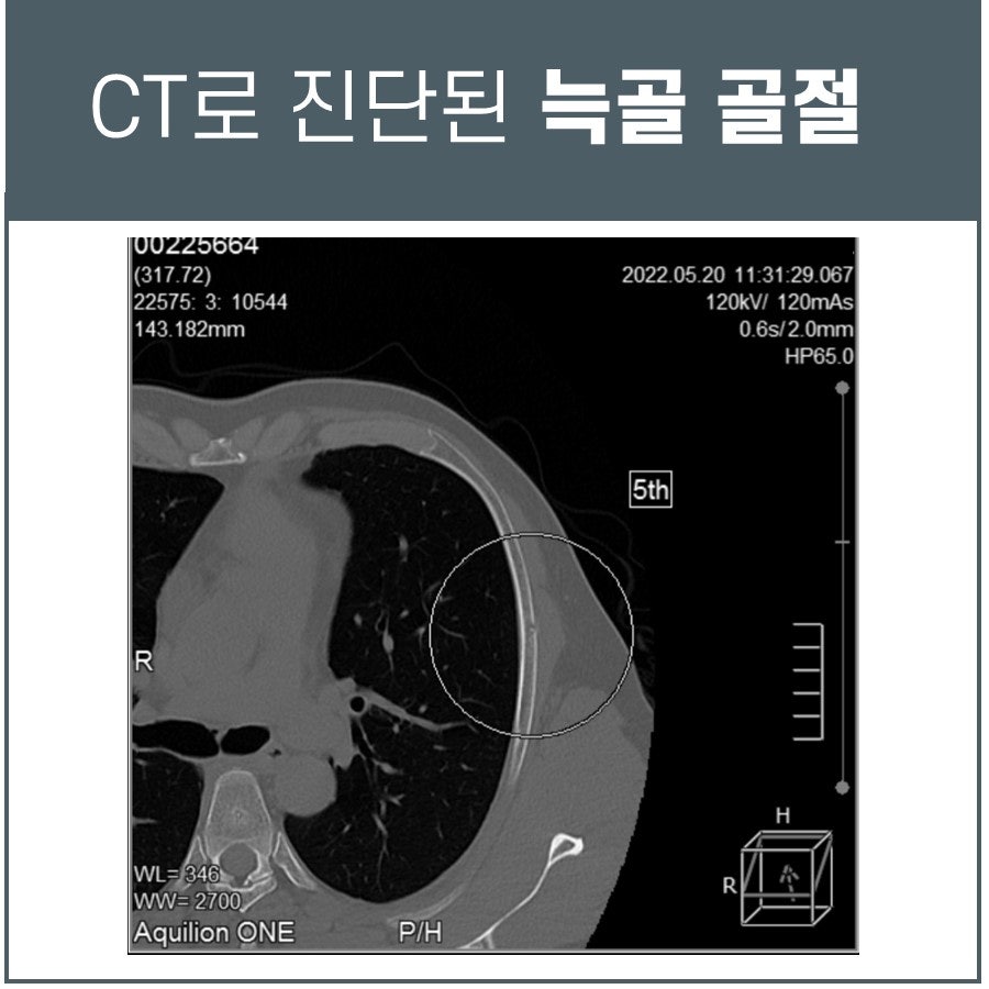 흉부 CT 영상에서 늑골 골절이 원으로 표시되어 있다.