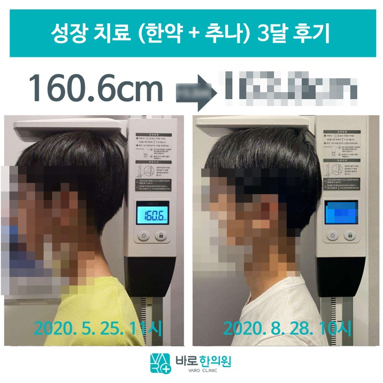 키 측정 기계에 서 있는 아이의 성장 치료 전후 옆모습 비교 사진. 왼쪽에는 160.6cm가 표시되어 있다.