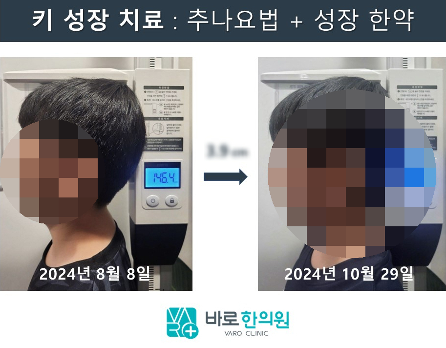 키 성장 치료 전후를 비교하는 사진으로, 2024년 8월 8일 146.4cm에서 2024년 10월 29일 3.9cm 성장한 아이의 모습.