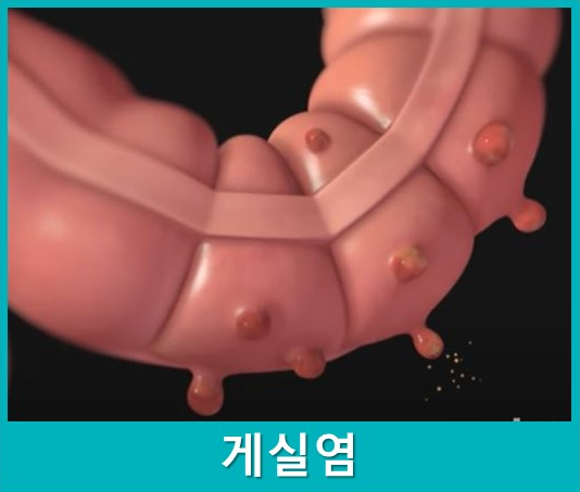 게실염이 발생한 장의 3D 일러스트 이미지 — 서울 바로한의원 초음파 약침·도침