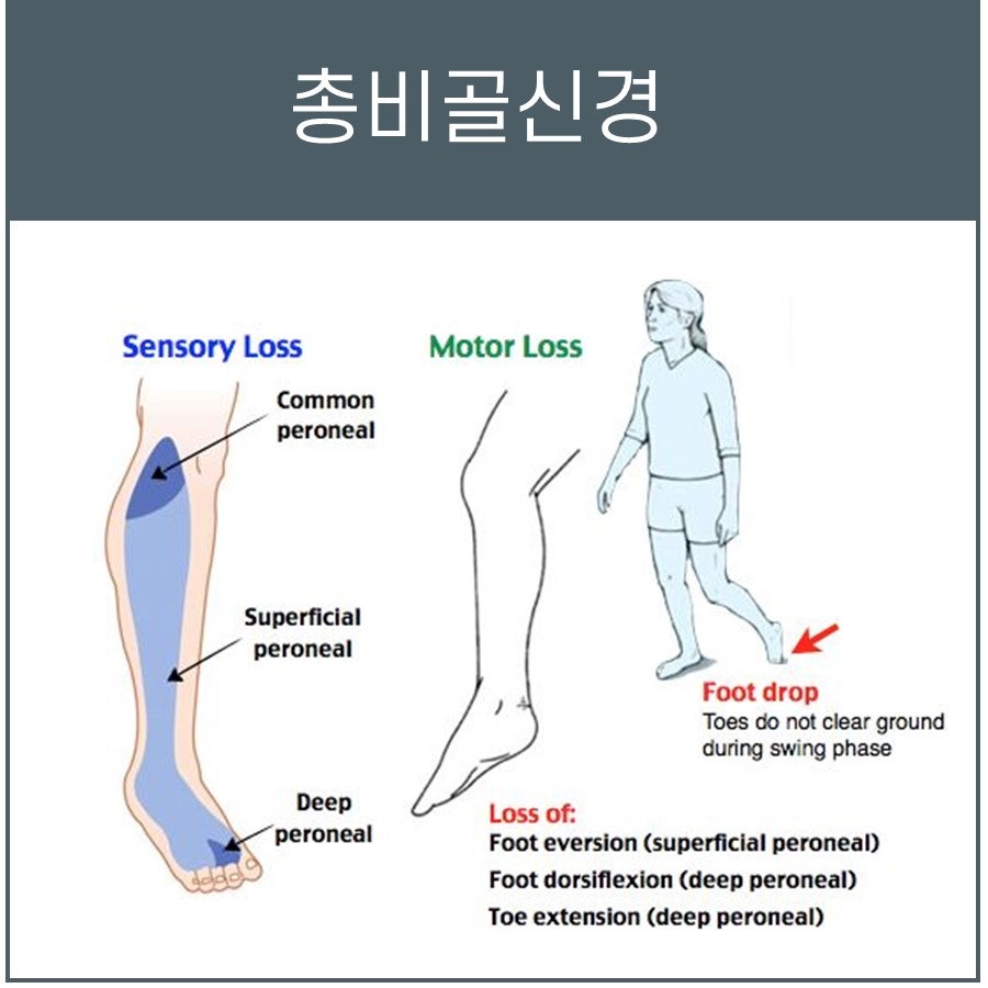 총비골신경 마비로 인한 감각 손실 부위와 족하수 등 운동 손실 증상을 보여주는 그림.