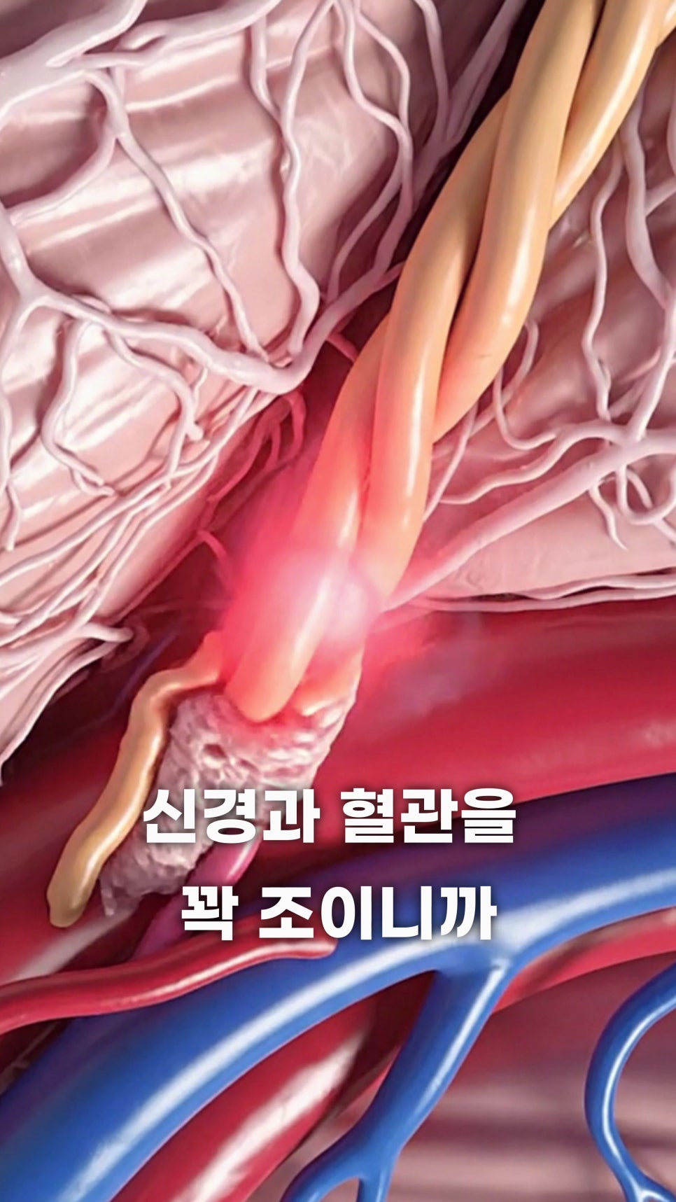신경 다발과 혈관이 얽혀 있는 모습과 한 부분이 붉게 빛나며 압박받는 것을 보여주는 3D 이미지