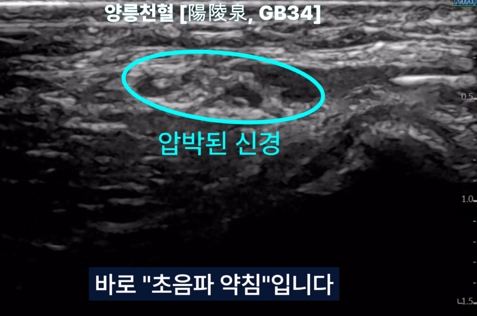 초음파 영상에서 양릉천혈 부위의 압박된 신경을 파란색 타원으로 표시한 모습
