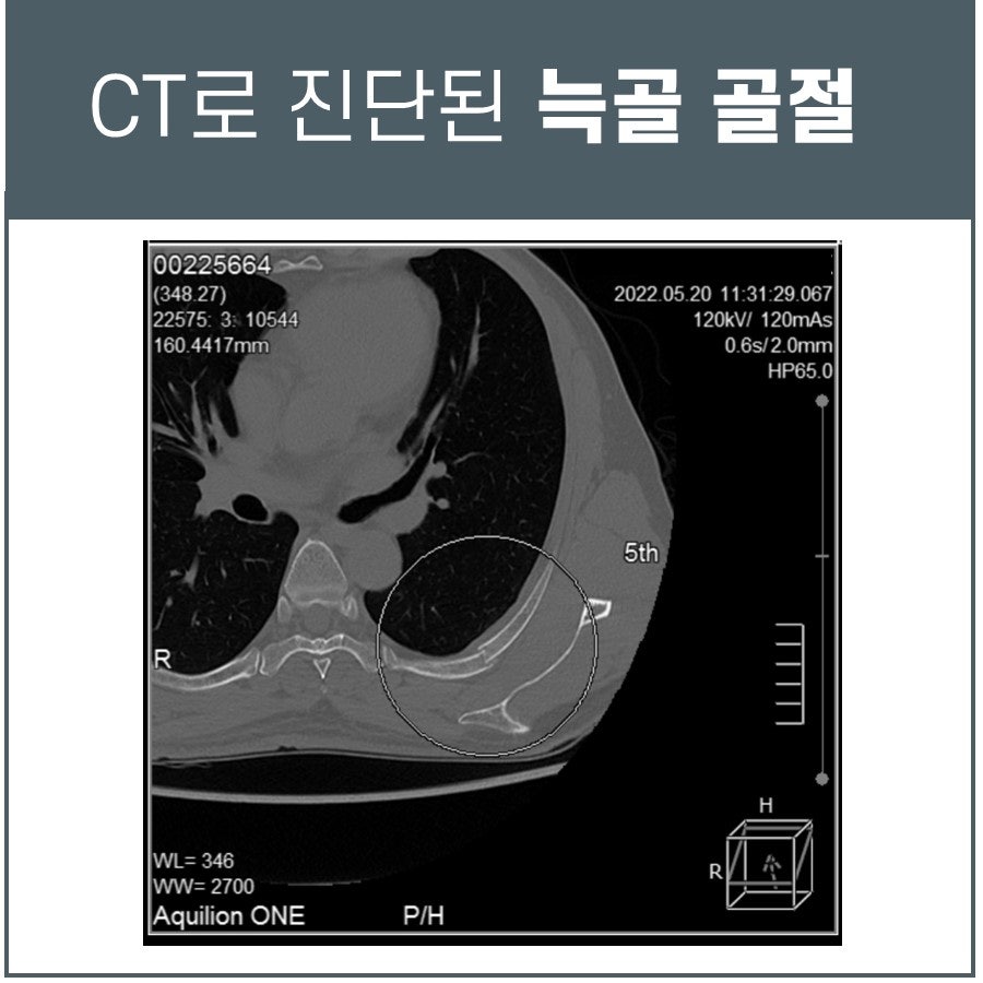 CT 영상에서 늑골 골절이 확인된 모습