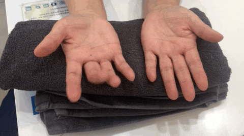 방아쇠 수지 증후군 치료, 도침 요법이 효과적입니다
