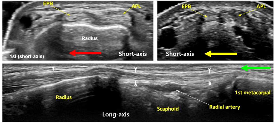손목 부위의 단축면 및 장축면 초음파 영상으로, 요골, 주상골, 첫째 중수골, 장무지외전근, 단무지신근, 요골동맥이 표시되어 있다.
