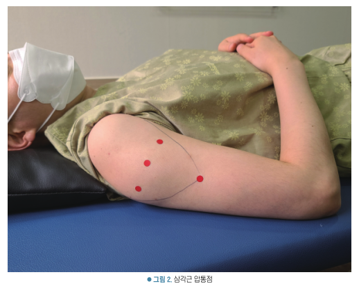 환자가 옆으로 누워 어깨와 팔에 삼각근 압통점이 표시된 모습
