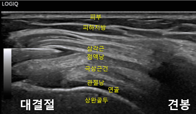 어깨 부위의 초음파 영상으로, 삼각근, 극상근건, 상완골두, 견봉 등 주요 해부학적 구조가 표시되어 있습니다.