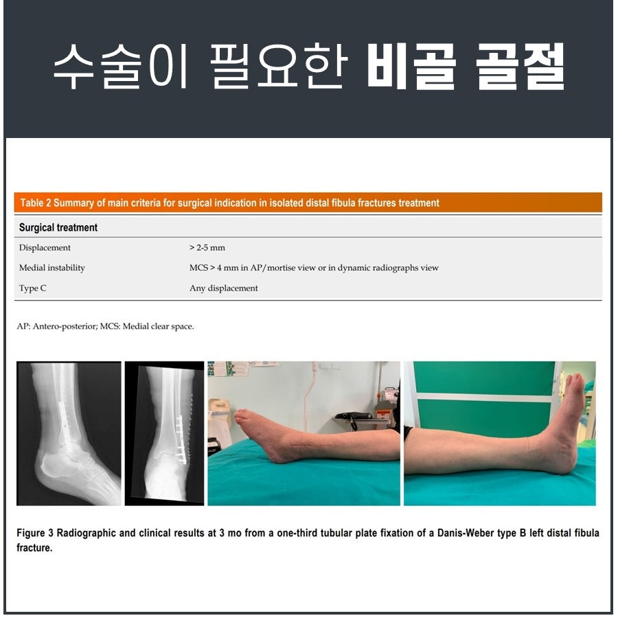 비골 골절 수술 기준을 요약한 표와 수술 후 3개월이 지난 발목의 엑스레이 사진 및 임상 사진.