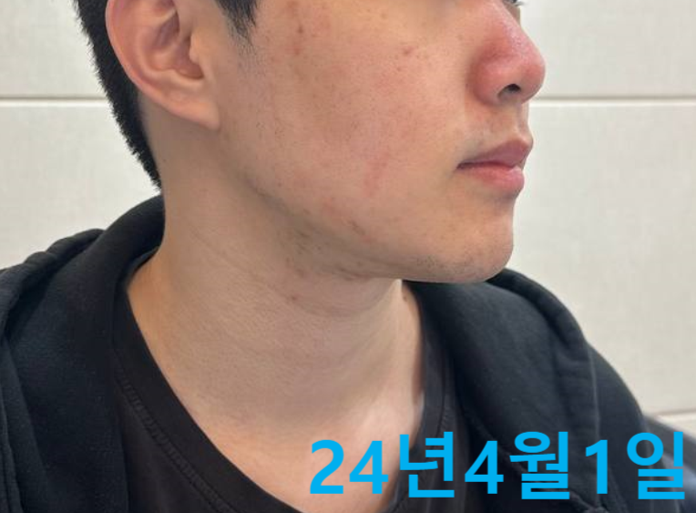 주사비 딸기코 주사피부염 한의원? 치료 사례 먼저 <확인>