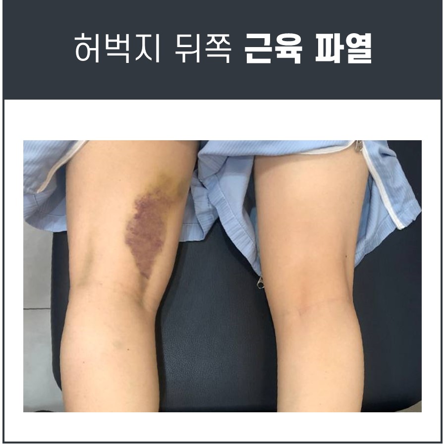 허벅지 뒤쪽 통증, 피멍, 햄스트링 파열 일 수 잇습니다.