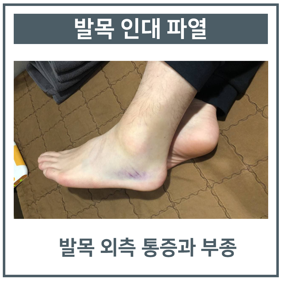 발목인대 늘어났을때, MRI 정밀 검사가 필요한 이유