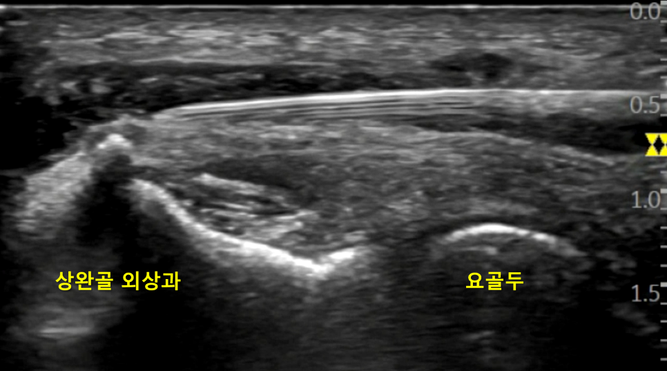 팔꿈치 관절에 침이 삽입된 경혈 초음파 이미지로, 상완골 외상과와 요골두가 표시되어 있습니다.