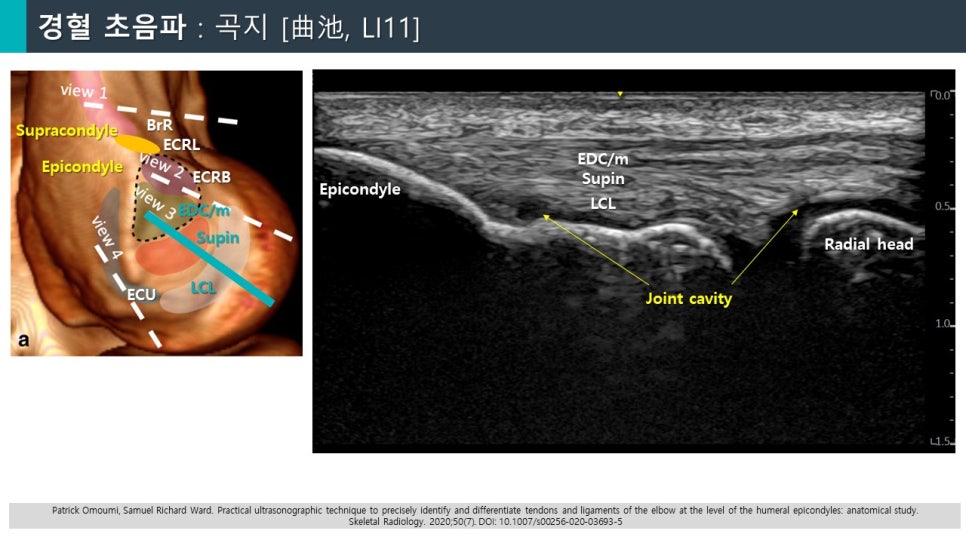 팔꿈치 바깥쪽의 해부학적 구조와 초음파 영상이 함께 나타난 이미지