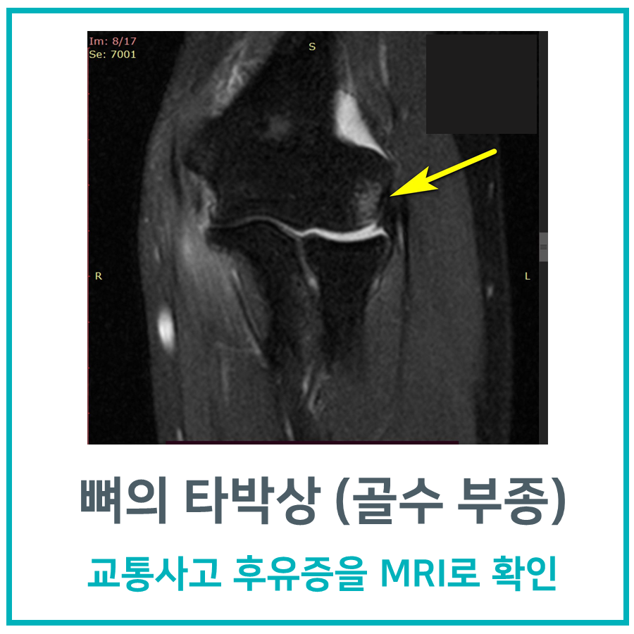 팔꿈치 관절 MRI 영상에서 뼈 타박상(골수 부종)이 노란색 화살표로 표시되어 있다.