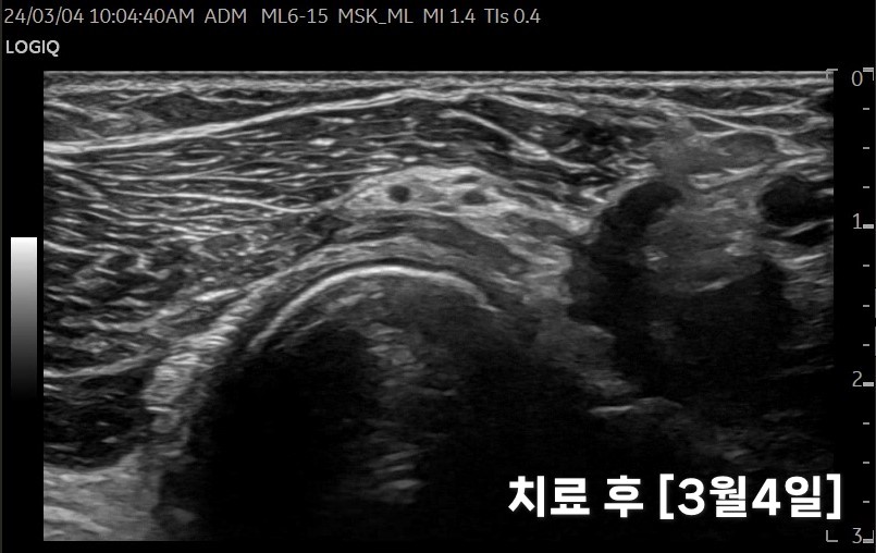 치료 후 팔꿈치 부위 내부 조직을 촬영한 초음파 영상.