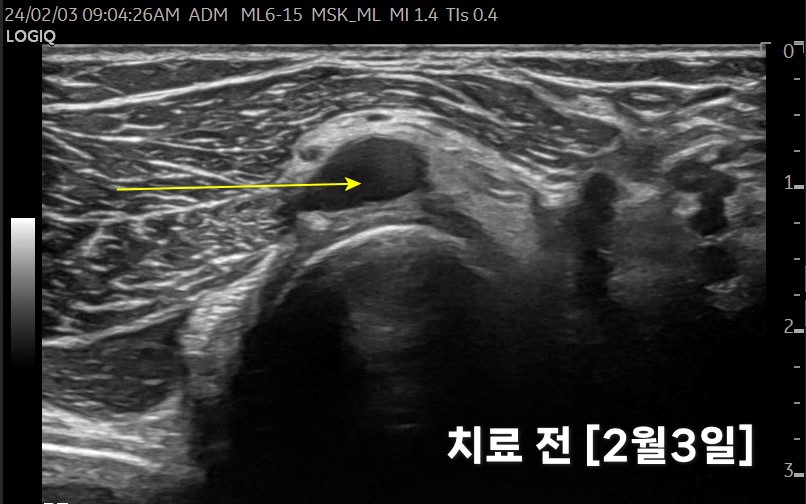 노란색 화살표로 가리킨 팔꿈치 부위의 물혹 초음파 사진. 하단에 '치료 전 [2월3일]' 문구가 있다.