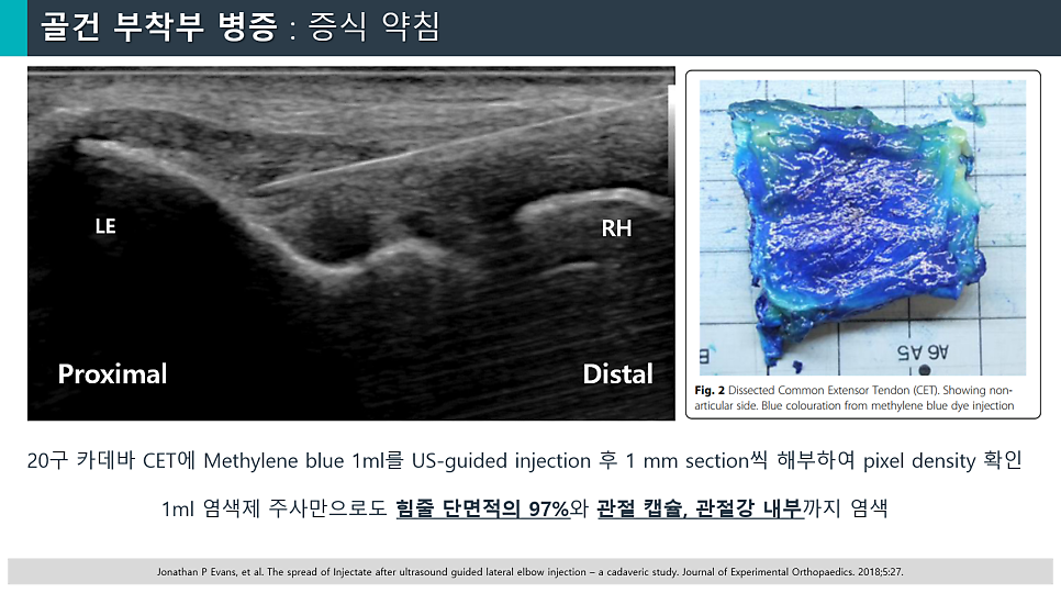 초음파 영상에서 팔꿈치에 주사 바늘이 삽입된 모습과 메틸렌 블루로 염색된 해부된 팔꿈치 힘줄 조직.