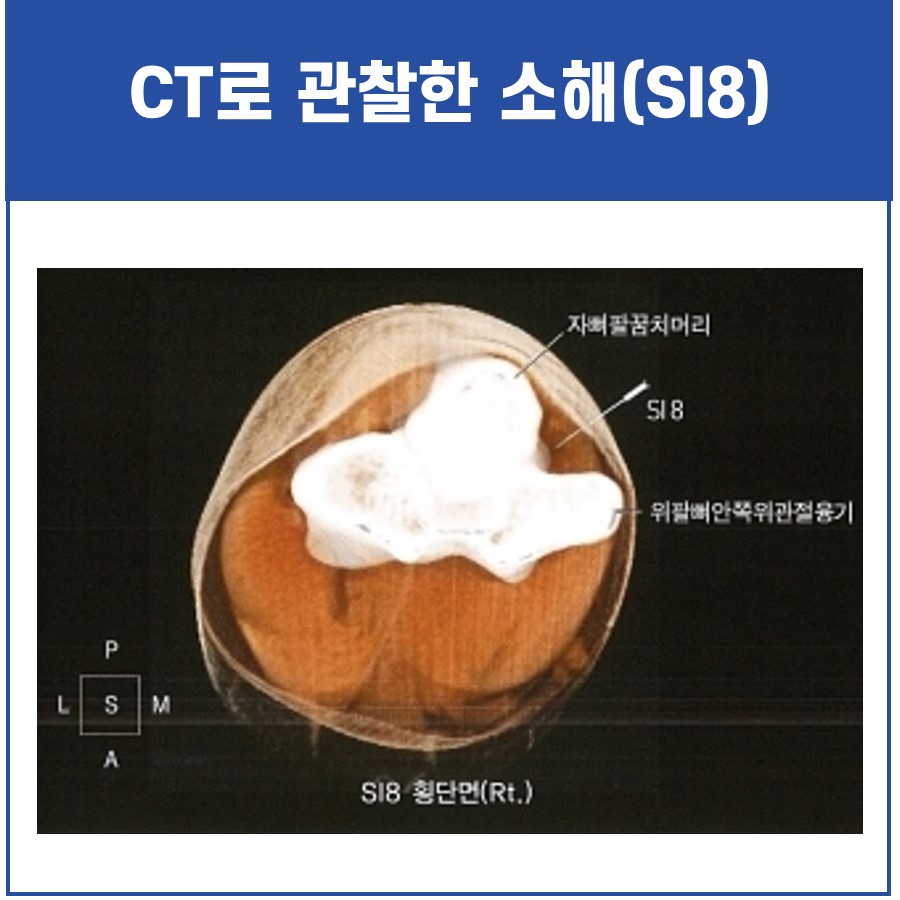 오른쪽 팔꿈치 관절의 소해(SI8) 혈자리 부위 CT 횡단면 이미지 — 서울 바로한의원 초음파 약침·도침