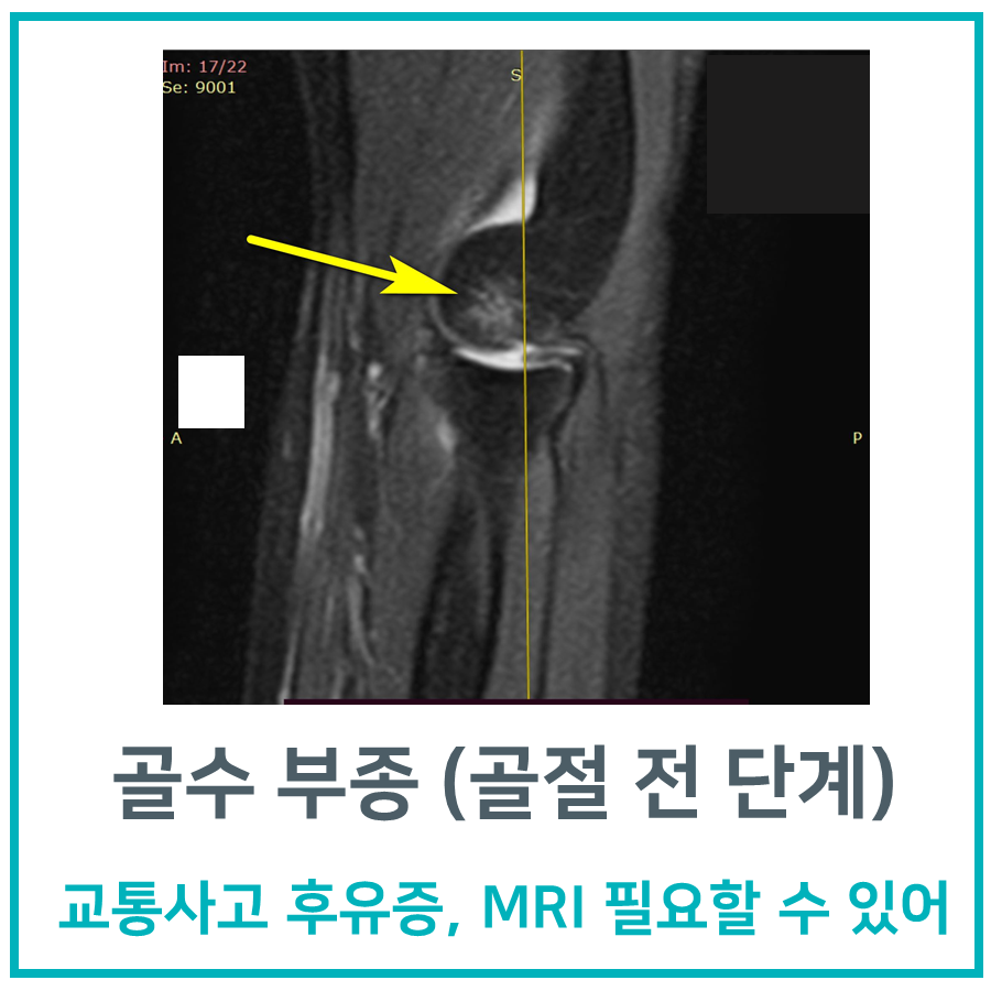 팔꿈치 MRI 영상에서 노란색 화살표가 골수 부종 부위를 가리키고 있습니다.