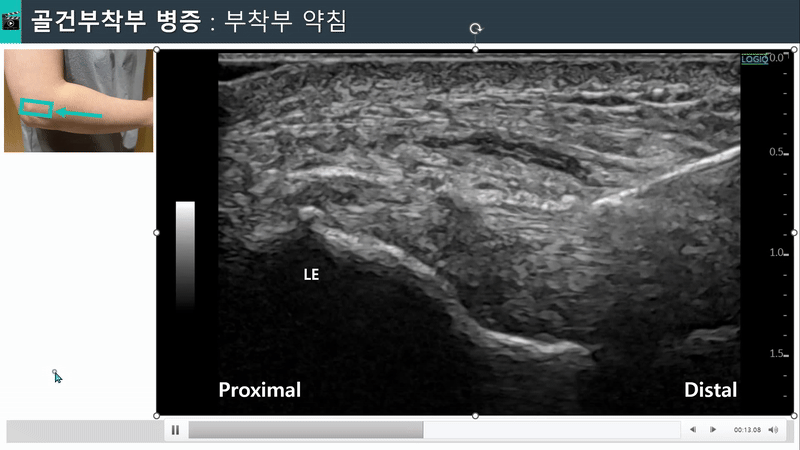 팔꿈치 부위에 약침 주입을 위해 초음파로 바늘을 확인하는 모습