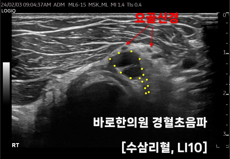 팔꿈치 부위 요골신경과 수삼리혈(LI10)을 표시한 초음파 사진