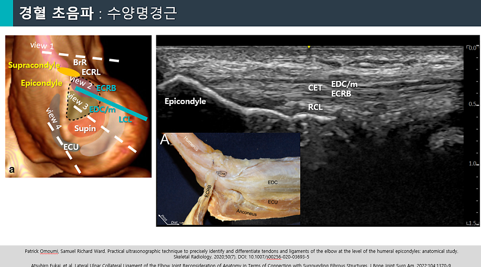 팔꿈치 바깥쪽 힘줄의 해부학적 구조와 초음파 영상