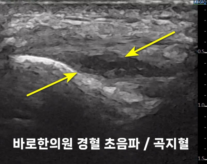 팔꿈치 부위의 초음파 사진으로, 두 개의 노란색 화살표가 내부 조직을 가리키고 있습니다.