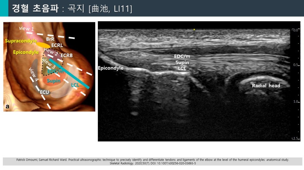팔꿈치 바깥쪽의 해부학적 구조와 초음파 영상이 함께 제시된 이미지