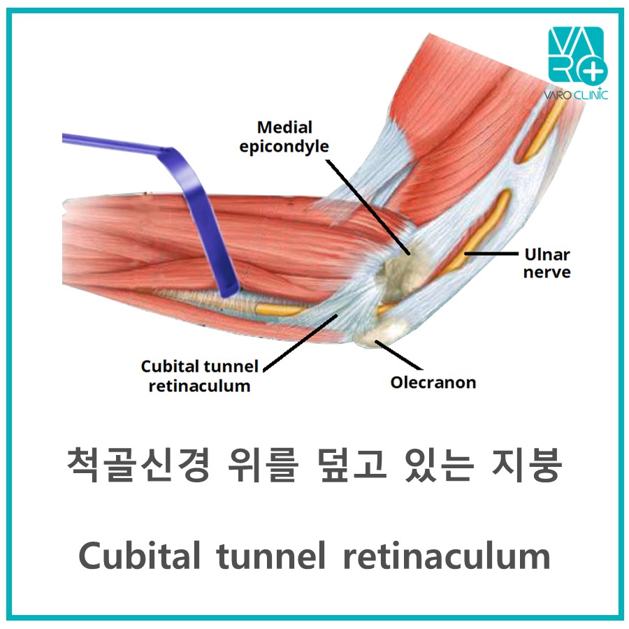 팔꿈치 척골신경과 팔꿈치터널 지붕인 척골신경포착대를 나타내는 해부학적 그림
