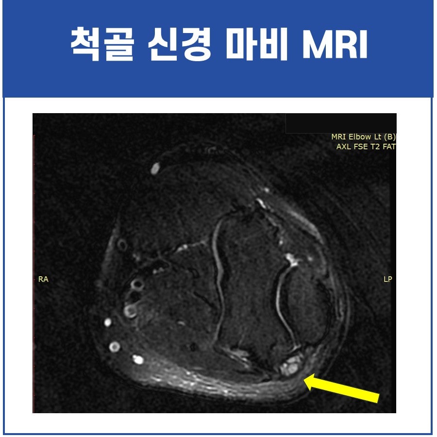 팔꿈치 MRI 영상으로, 노란색 화살표가 한 부위를 가리키고 있다 — 서울 바로한의원 초음파 약침·도침