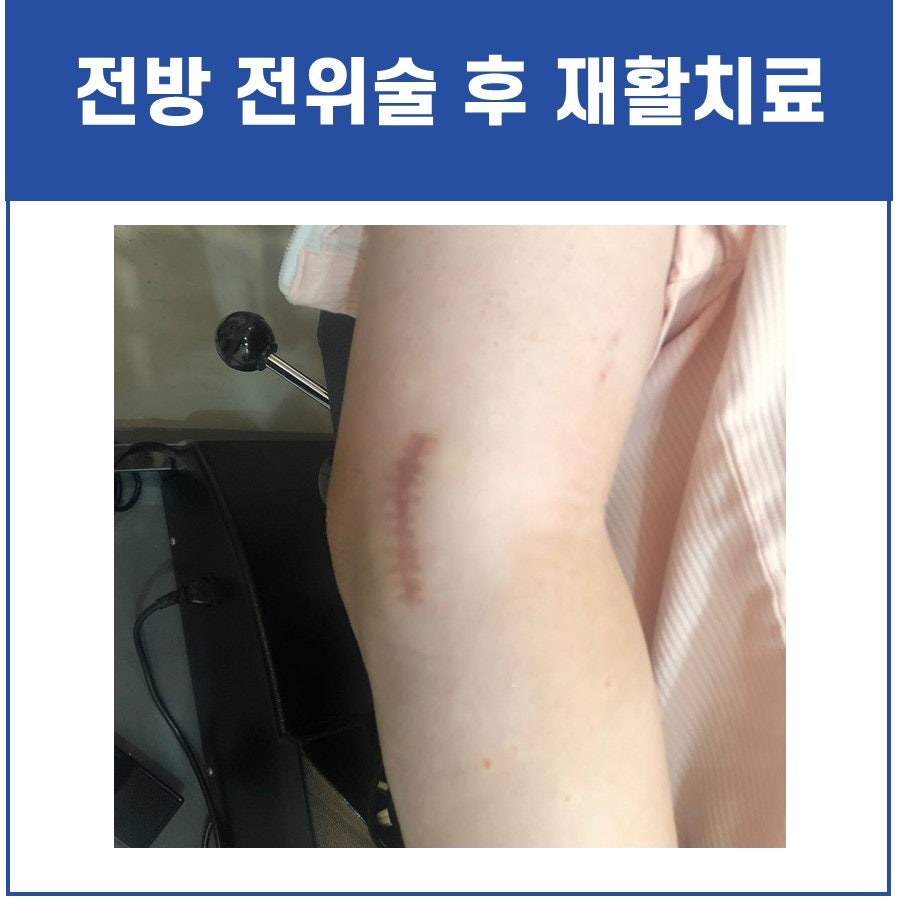 팔꿈치 안쪽 통증, 척골 신경 마비는 MRI 검사가 필요합니다